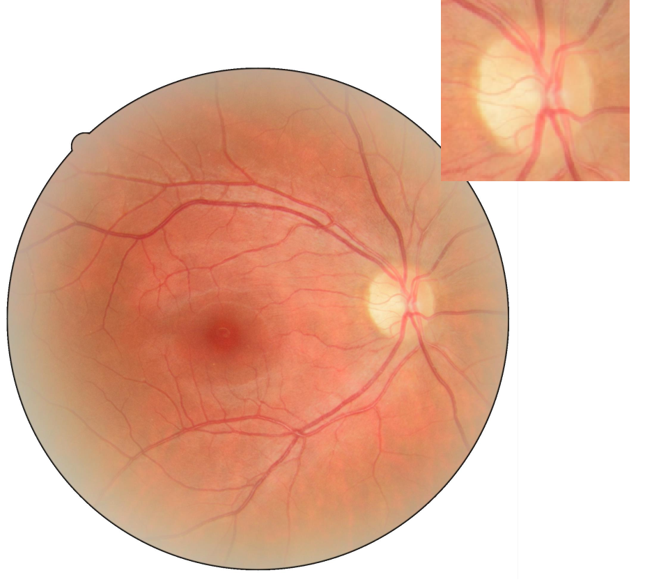 Нейропатия глаза. Неврит зрительного нерва глазное дно. Атрофия зрительного нерва глазное дно. Неврит зрительного нерва офтальмоскопия. Ретробульбарный неврит зрительного нерва.