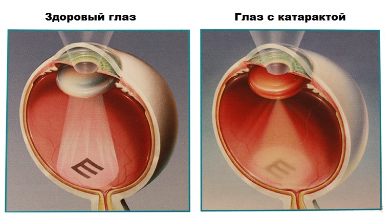 Лечение катаракты в пожилом возрасте