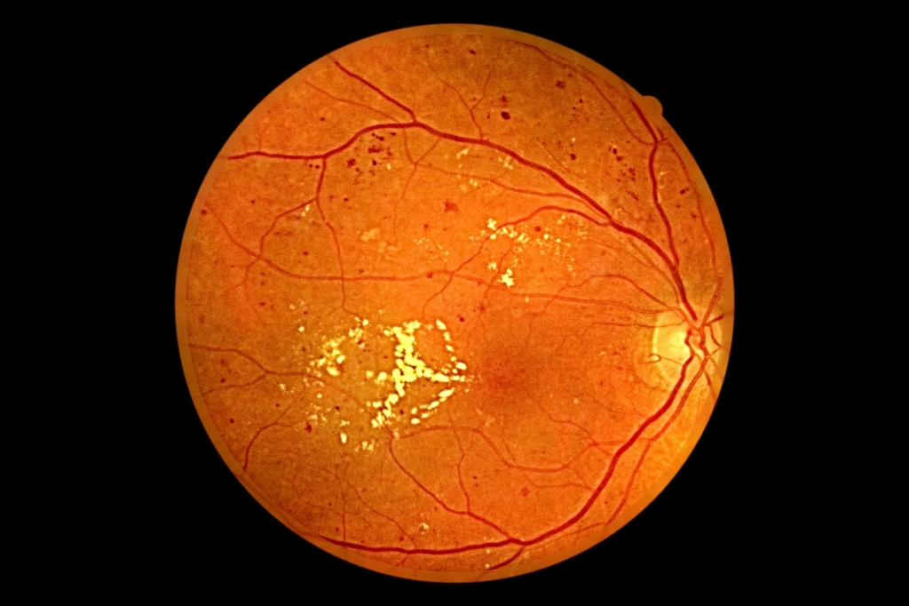 Препролиферативная диабетическая ретинопатия