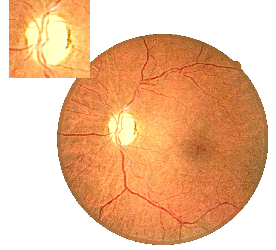Неврит зрительного нерва: причины, симптомы и лечение